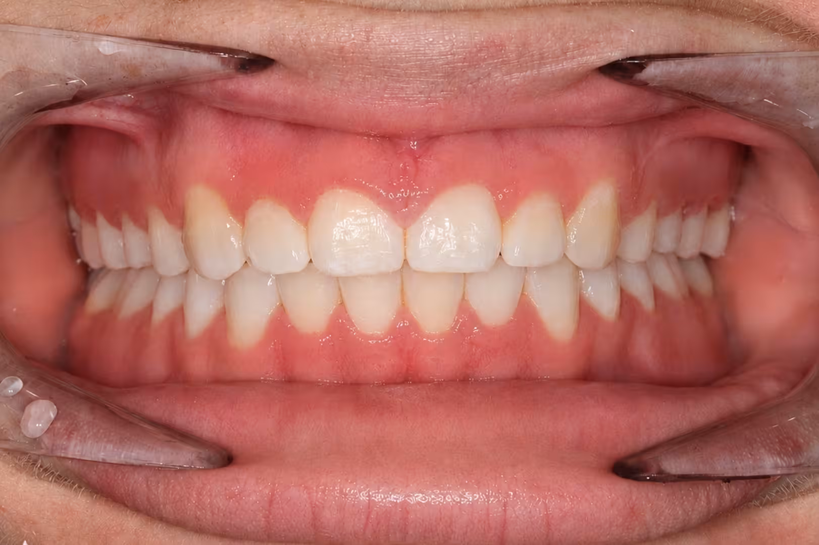 Ashley — after orthodontic treatment at Linea