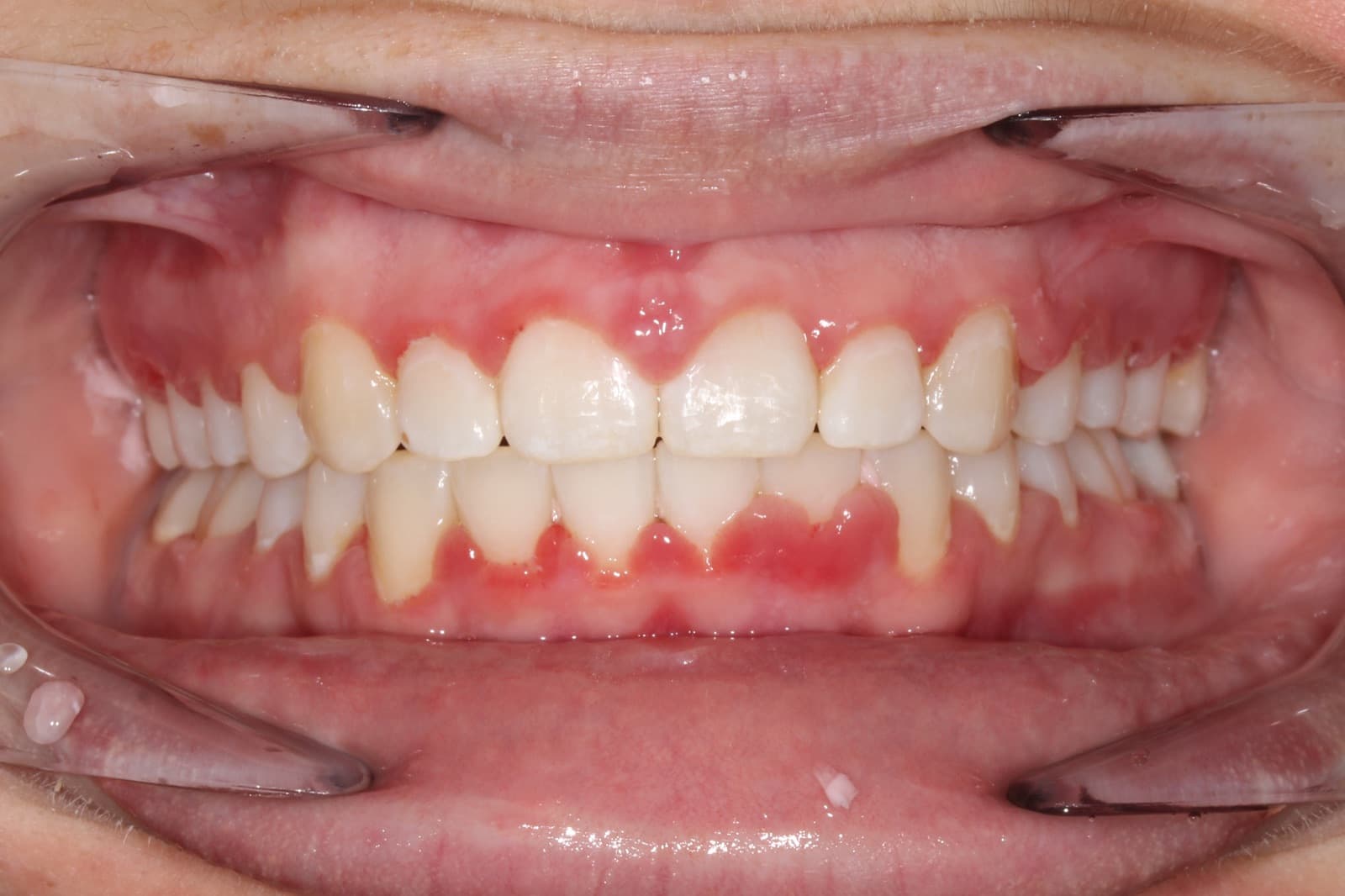 Ashley — after orthodontic treatment at Linea