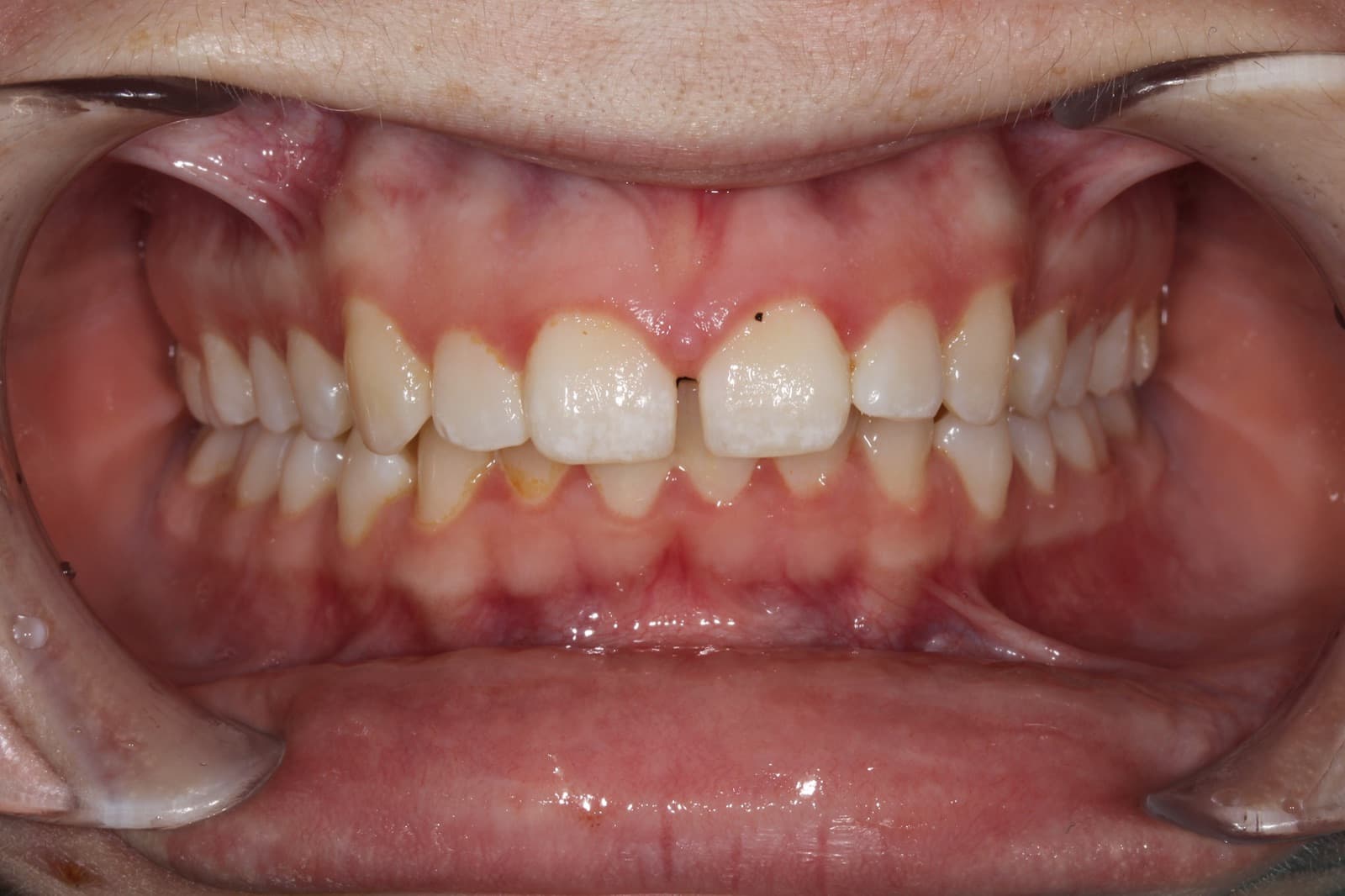 Ashley — before orthodontic treatment at Linea