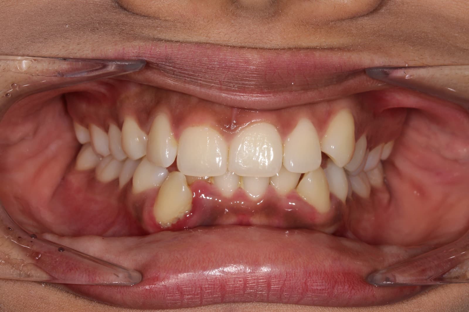 Chavez — before orthodontic treatment at Linea