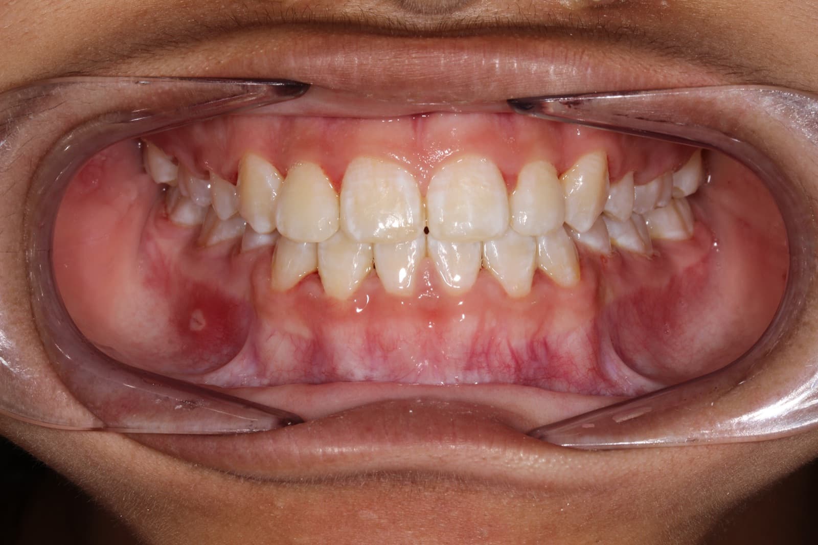 Linda — after orthodontic treatment at Linea